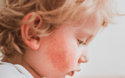 Mon enfant est allergique, quelles assurances souscrire ?